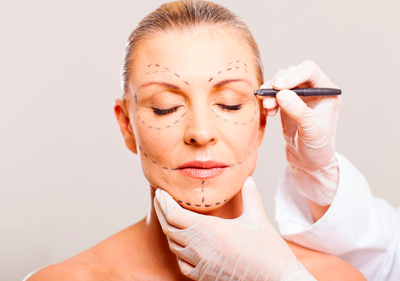 Lifting Facial o Ritidoplastia PlasticSkin